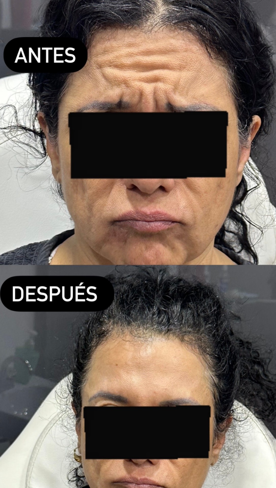 Toxina Botulínica — Antes / Después