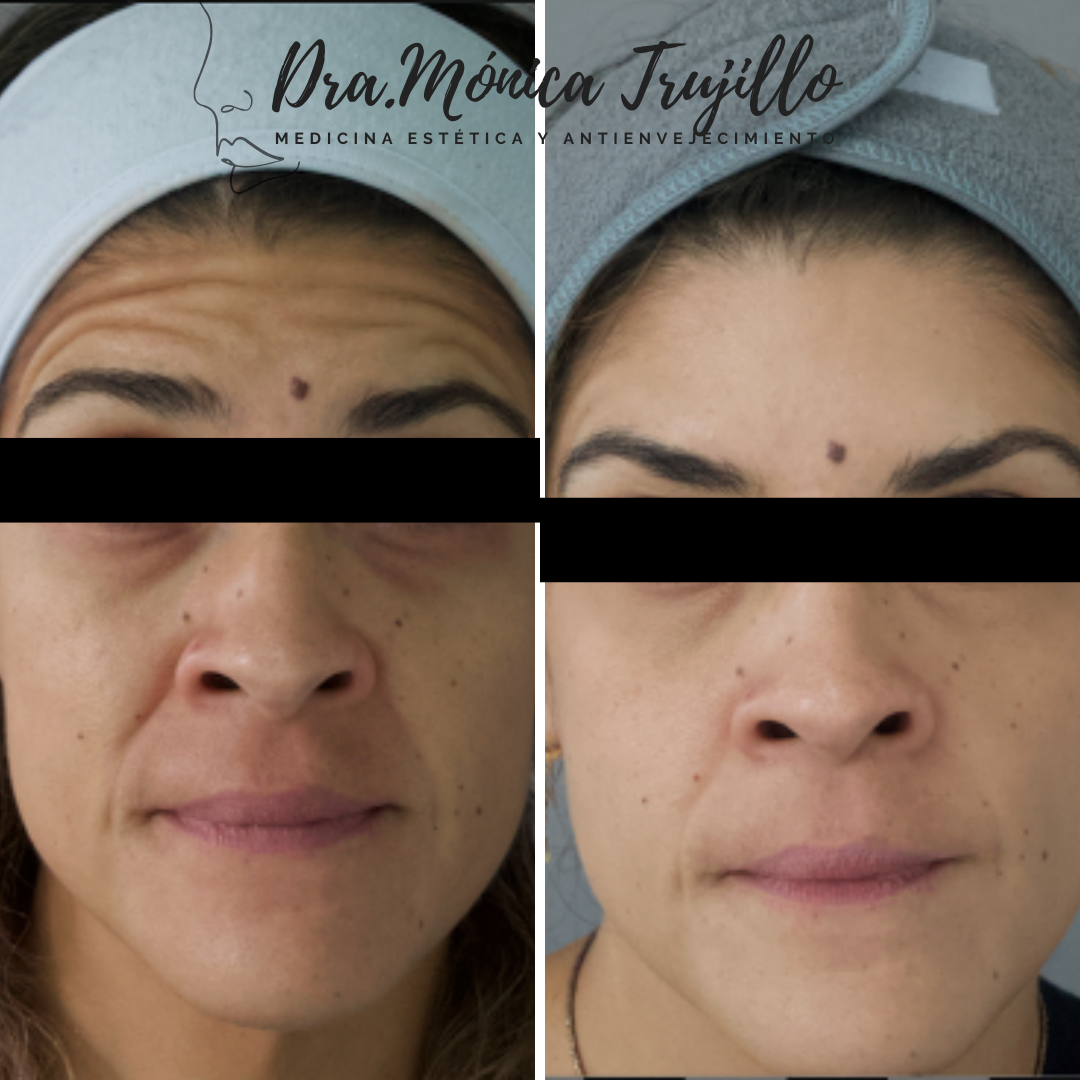 Toxina Botulínica — Antes / Después